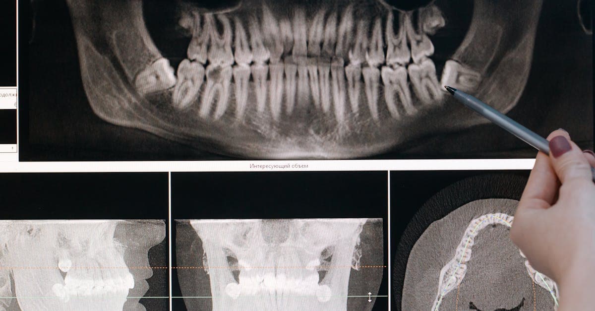 Cover Image for Unveiling the Secret to a Perfect Smile: Invisible Teeth Aligners Explained